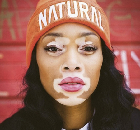 top-model-vitiligo-chatelle Winnie-chantelle-winnie-modella-favola-principessa-perfezione-imperfezione-vitiligine-non-si-dice-piacere-blog